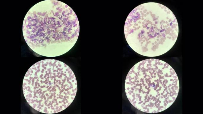 停止运动VDO酵母细胞被血液涂片中的白细胞吞噬。真菌血液感染。