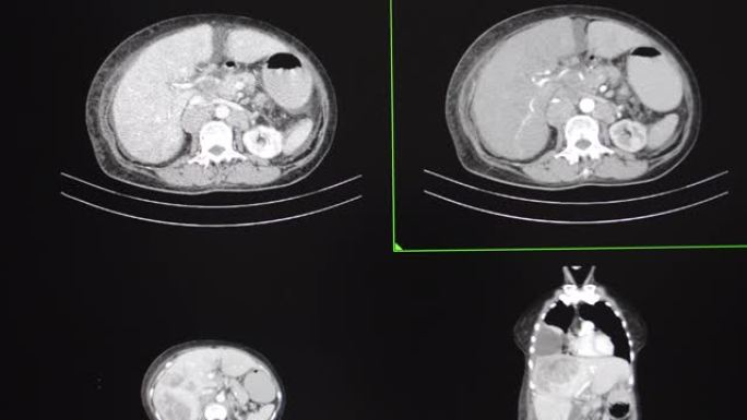 女性晚期宫颈癌转移患者的胸部和腹部ct扫描