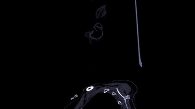 CT C-脊柱或颈椎矢状位视图。