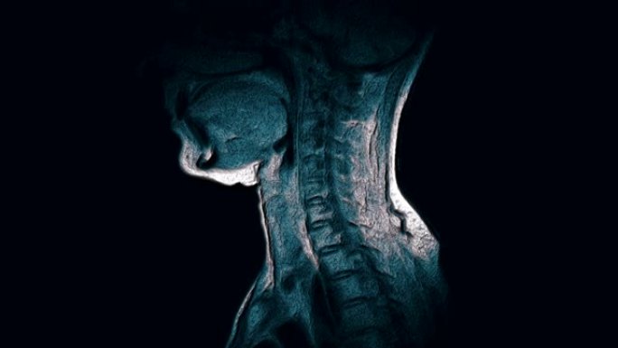 颈椎的大量彩色MRI，突出物和疝气的检测