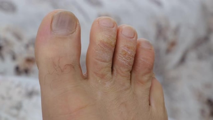 男人脚趾上的真菌感染，被忽视的男性脚趾，