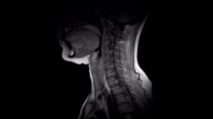 颈椎MRI，检测突起和疝气