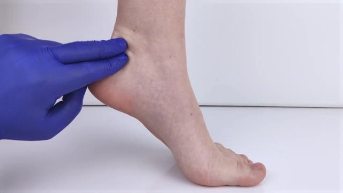 骨科医生检查女人的腿。脚跟疼痛，肌腱拉伸，炎症，脚跟骨刺。足部疾病治疗理念