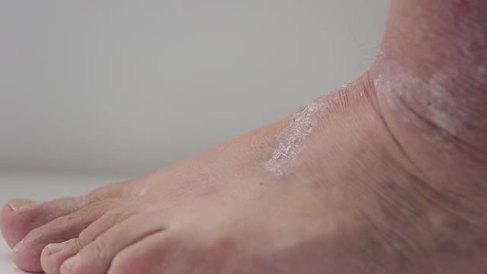 牛皮癣。一名男子梳理受银屑病斑块影响的足部区域特写