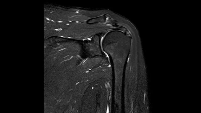 MRI示左肩袖撕裂史，疑似左肩脂肪瘤，肩胛下肌腱关节侧部分撕裂，左上臂后外侧脂肪瘤。