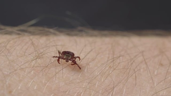 吸血螨蜱通过头发在人的皮肤上爬行