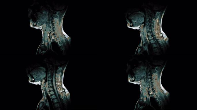 颈椎的整体彩色MRI，突起和疝气的检测