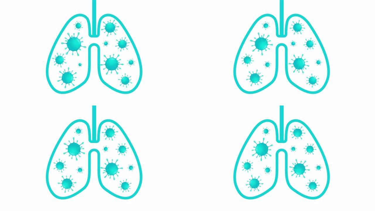新型冠状病毒肺炎或电晕病毒在人的肺和呼吸系统。