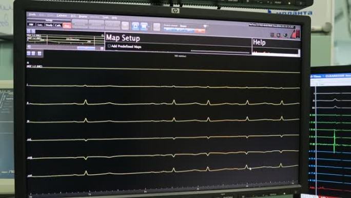 心脏在监视器上的心电图