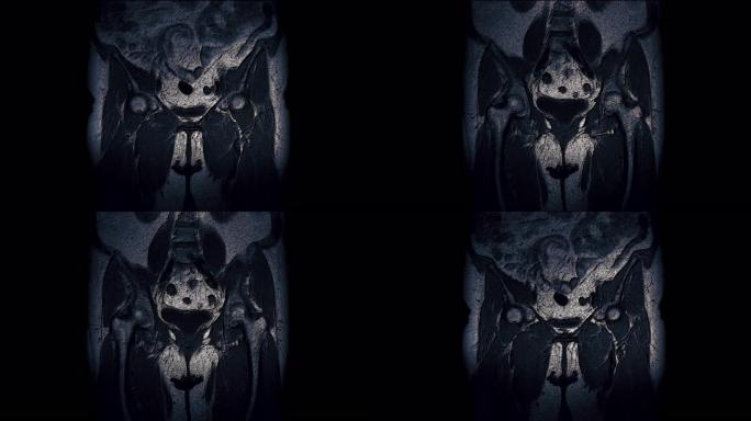 女性器官术后大量彩色MRI检测转移灶