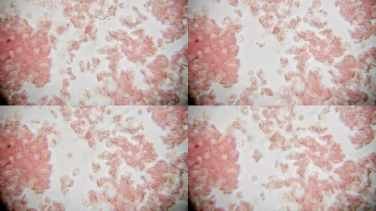 在1000倍显微镜视图上看到的新鲜血液。显微镜下的血液涂片显示血浆，白细胞和红细胞