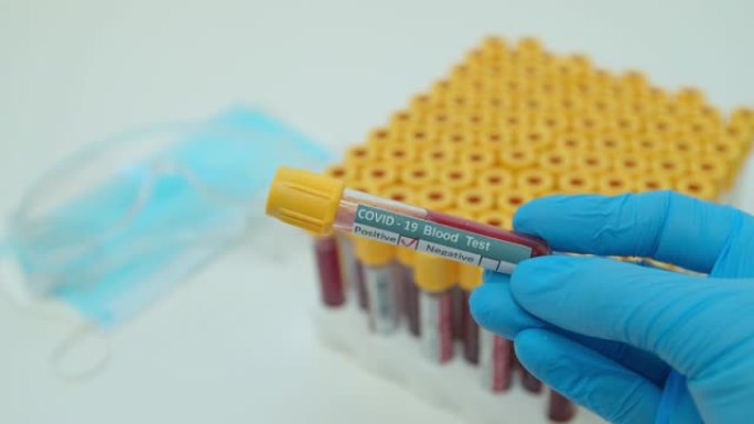 研究者手示管，冠状病毒血液检查阳性结果，covid-2。