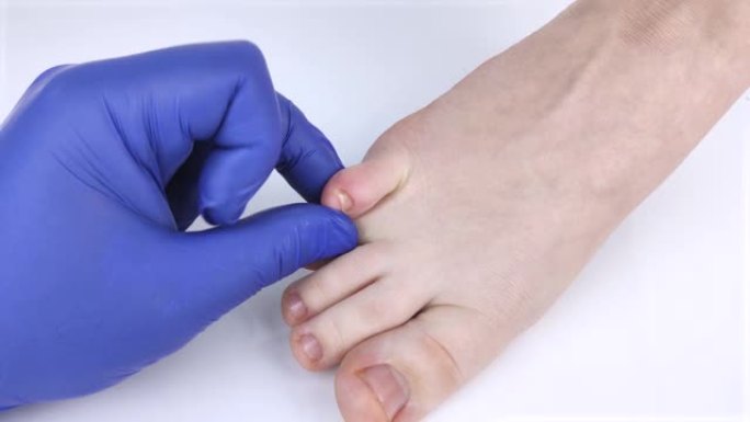 podologist医生检查了女人脚上指甲的真菌。治疗甲真菌病、真菌病。变形钉板