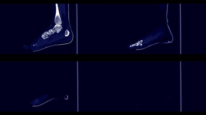 CT足部矢状面诊断足部骨折。