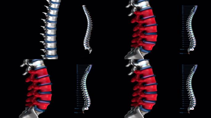 人体脊柱-金属-腰椎
