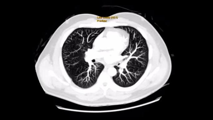 CT胸部或ct扫描人体胸部冠状位MIP视图用肺滤过技术诊断结核病、结核病和新型冠状病毒肺炎。