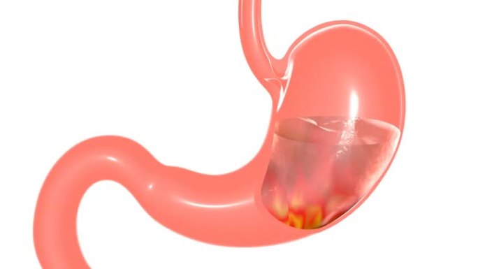 胃灼热的解剖3D动画。