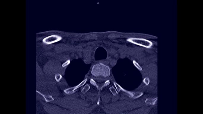 CT C脊柱或颈椎轴位视图的患者创伤病例，用于检测c脊柱骨折。