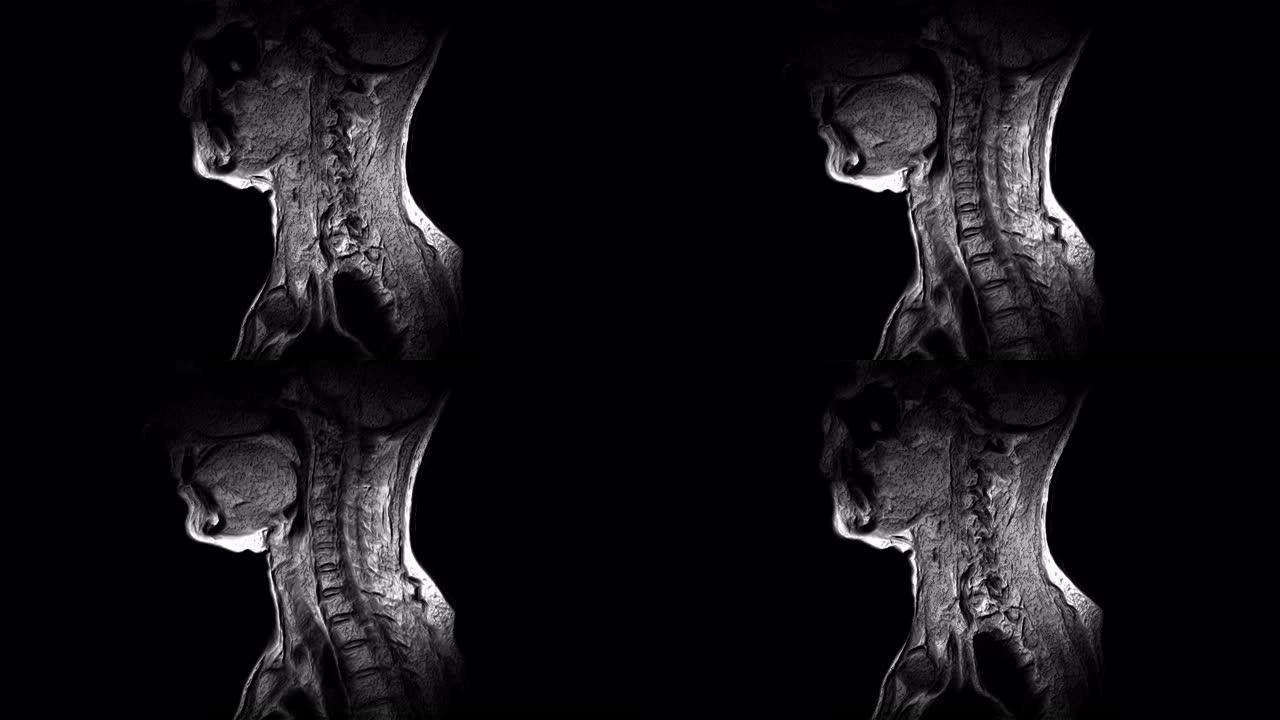 颈椎的大量MRI，突出物和疝气的检测