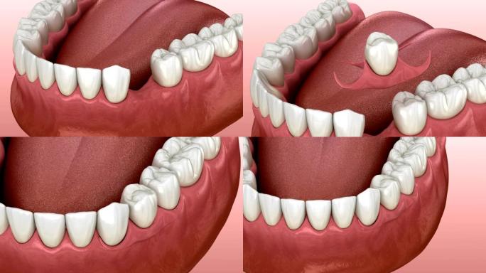 假牙 替换一颗缺失的牙齿3D动画