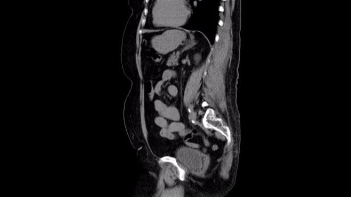 腹腔、胃肠道、膀胱的MRI