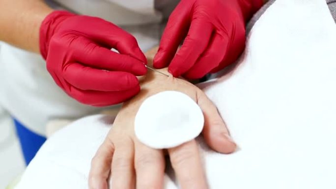 医生美容师皮肤科医生进行了一次中胚层疗法或生物evitalization-去除老年妇女手上的色素沉着