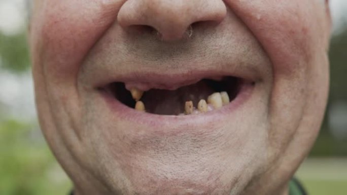 男人的牙齿掉了出来，黄色和黑色的牙齿疼。牙齿状况不佳，糜烂，龋齿。