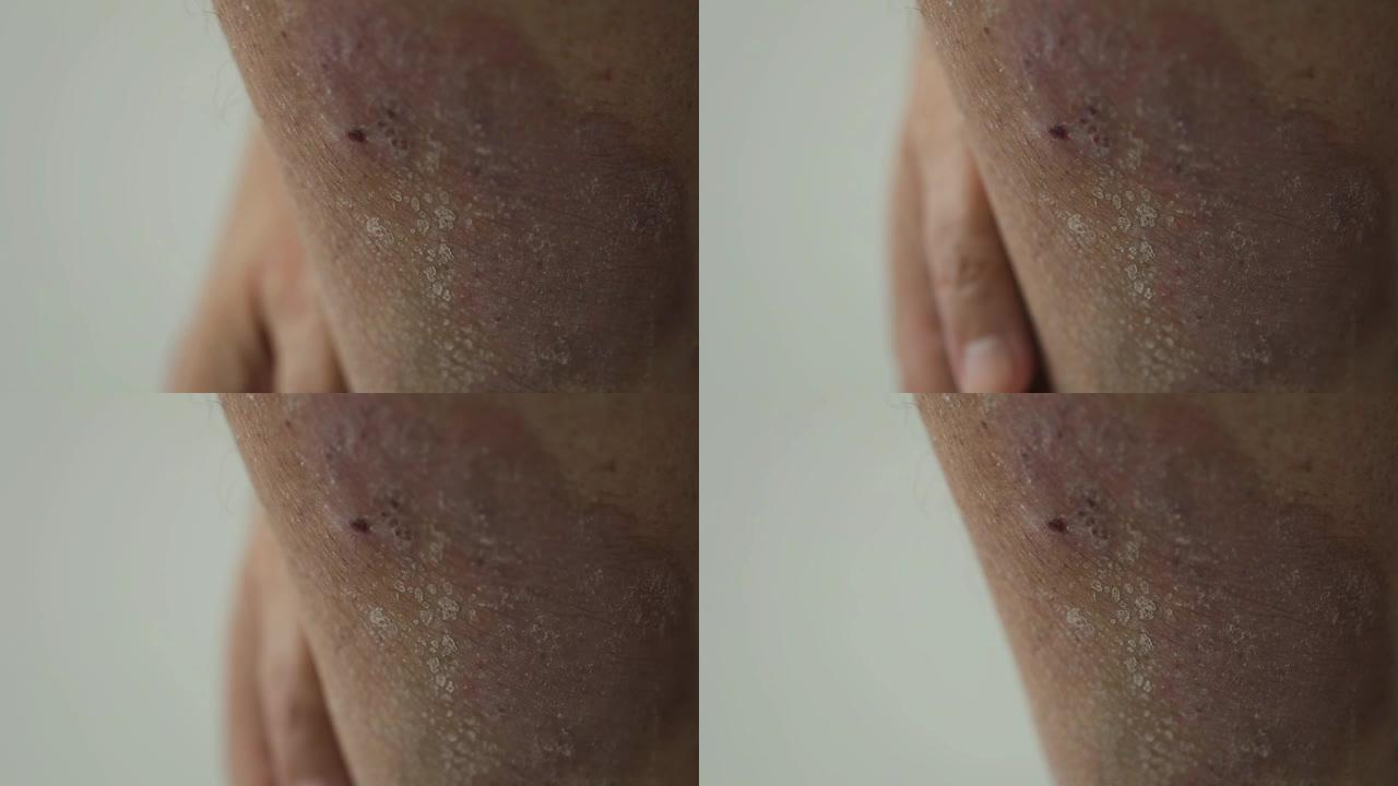 牛皮癣。一名男子梳理受银屑病斑块，皮疹和伤口影响的小腿区域。特写。