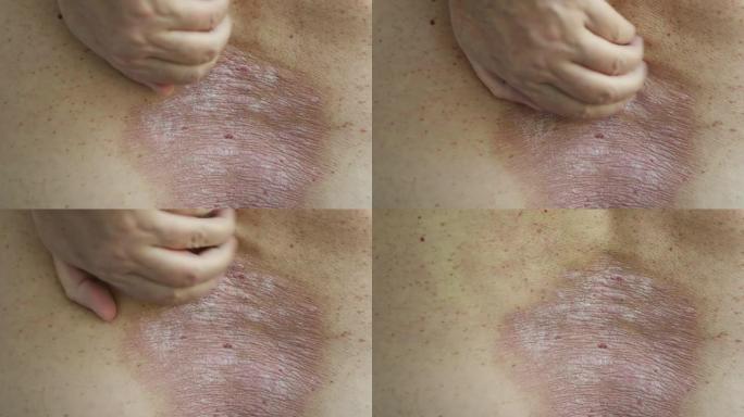 牛皮癣: 一个男人用手在受牛皮癣皮疹和斑块影响的背部区域上的特写镜头
