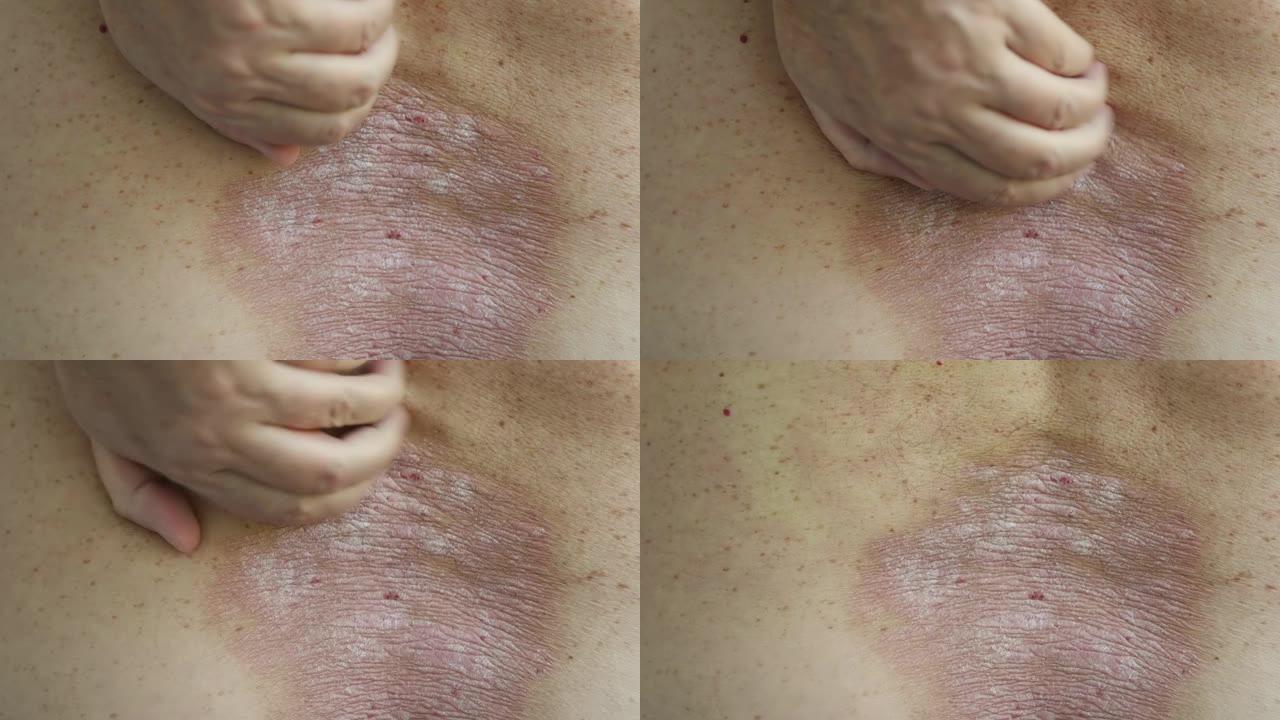 牛皮癣: 一个男人用手在受牛皮癣皮疹和斑块影响的背部区域上的特写镜头
