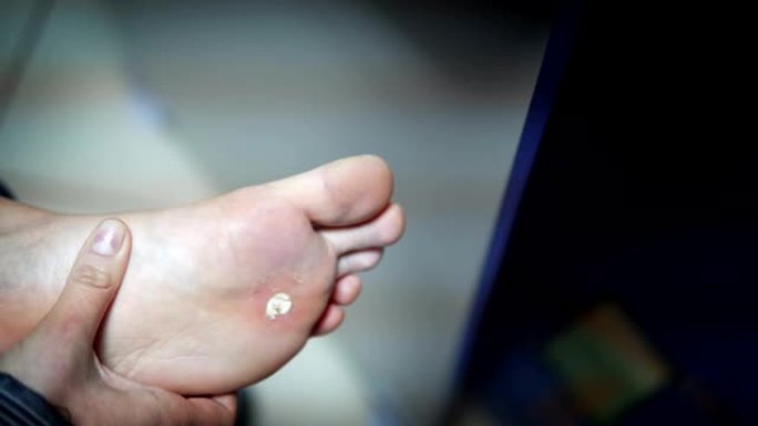 细菌感染的脚在患者身上，用冷冻疗法燃烧感染