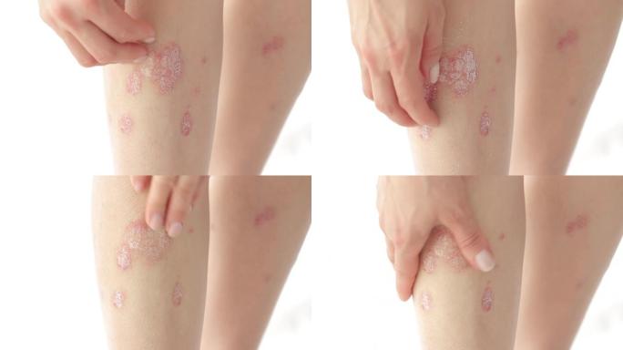 女性双手抓伤腿部急性银屑病，是一种无法治愈的自身免疫性皮肤病