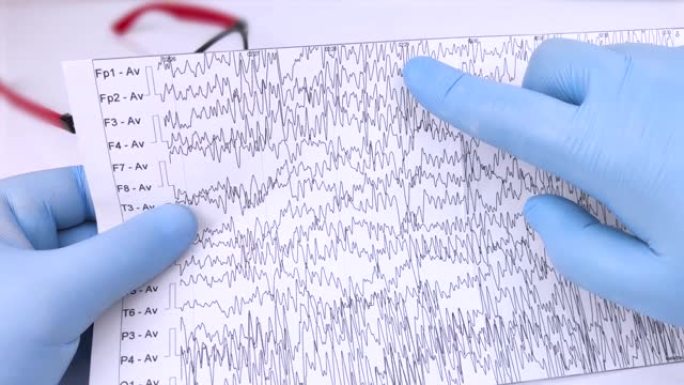 神经科医生检查患者大脑的脑电图。脑电图时间表-癫痫迹象和神经系统病理的脑电流研究
