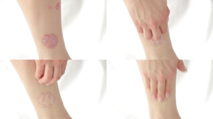女性双手抓伤腿部急性银屑病，是一种无法治愈的自身免疫性皮肤病