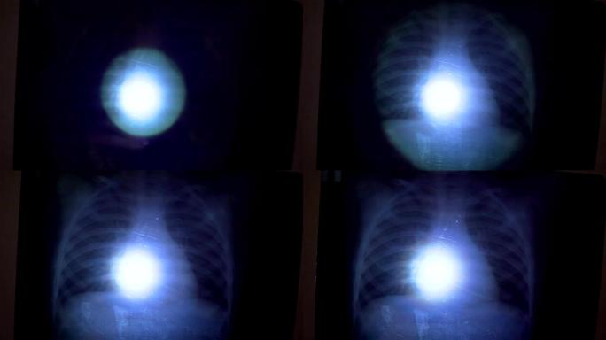 流行病学家在肺部x射线上照射手电筒，以驳斥世界电晕病毒的病毒性肺炎诊断