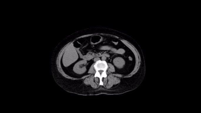 腹腔、胃肠道、膀胱的MRI