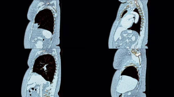 肺和支气管的彩色MRI，病毒性或新型冠状病毒肺炎呼吸道疾病的诊断