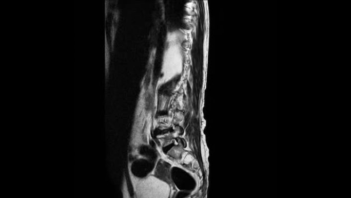 腰椎的MRI研究揭示了L2椎体爆裂性骨折并严重椎体塌陷和腰椎病从L1-2到L5-S1椎间盘。医学概念