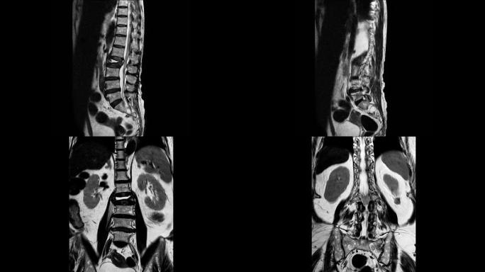 腰椎的MRI研究揭示了L2椎体爆裂性骨折并严重椎体塌陷和腰椎病从L1-2到L5-S1椎间盘。医学概念