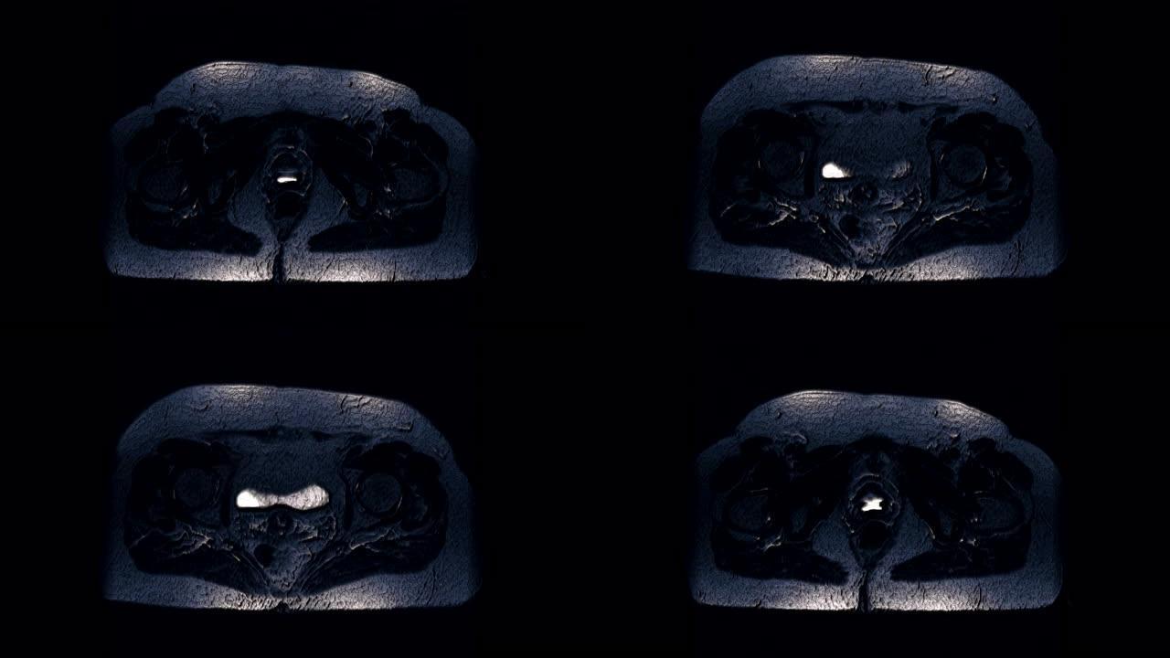女性器官术后大量彩色MRI检测转移灶