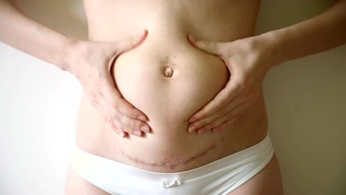妇女在caserean节分娩后抓住肚子上的松弛皮肤