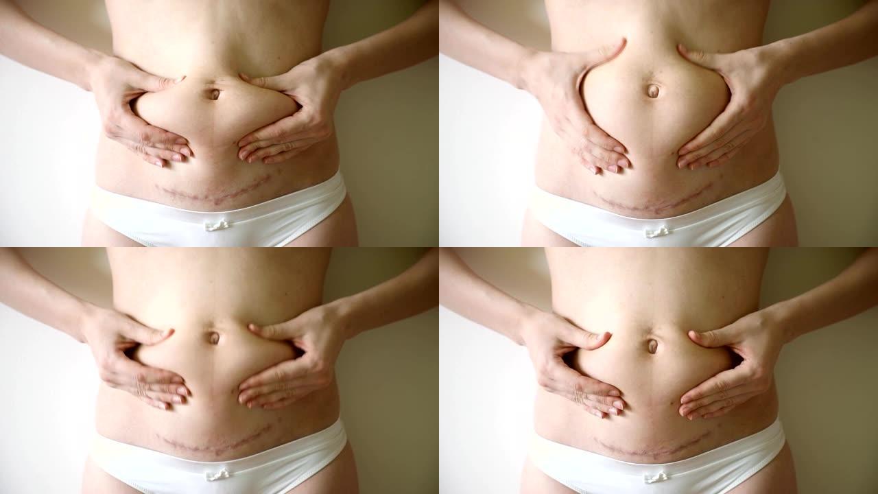 妇女在caserean节分娩后抓住肚子上的松弛皮肤