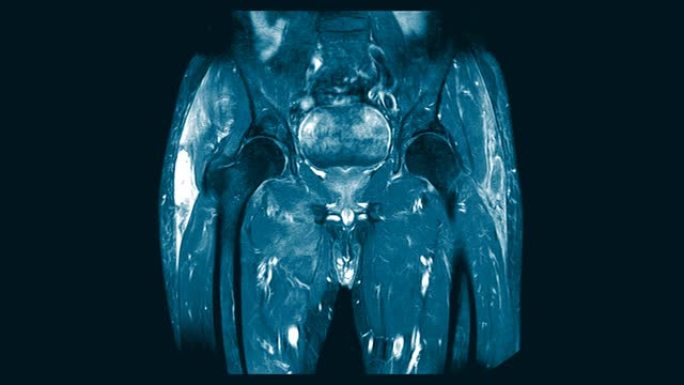 髋关节矢状面磁共振成像 (MRI)。在右臀大肌和臀中肌的肌内区域找到一个大型的混合异质液体集合。