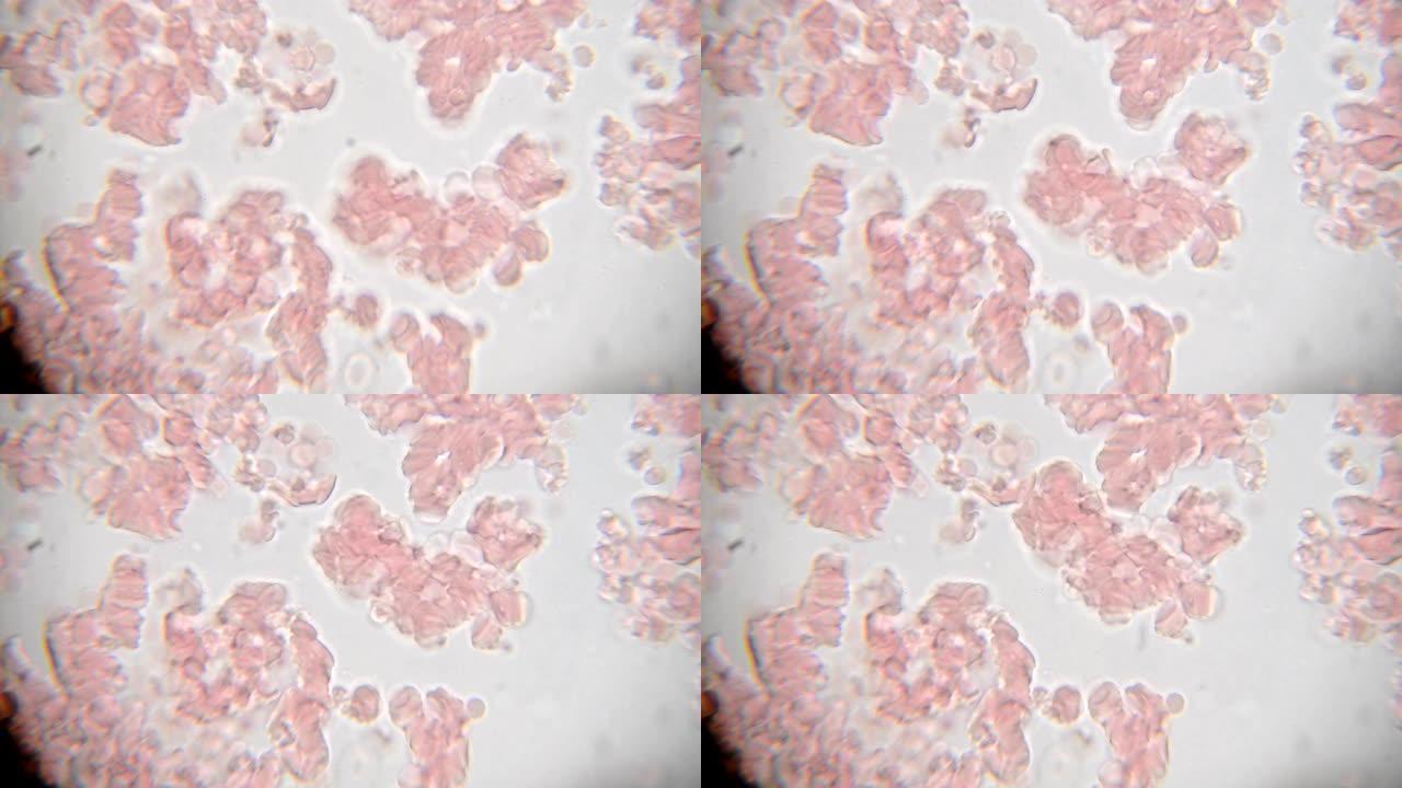 在1000倍显微镜视图上看到的新鲜血液。显微镜下的血液涂片显示血浆，白细胞和红细胞