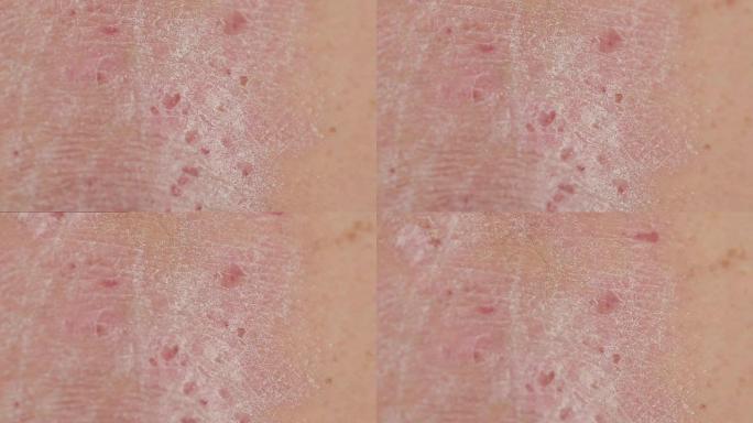 牛皮癣: 受牛皮癣伤口斑块影响的人背部皮肤区域皮疹