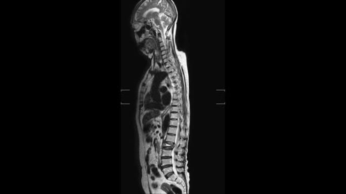 腰椎的MRI研究揭示了L2椎体爆裂性骨折并严重椎体塌陷和腰椎病从L1-2到L5-S1椎间盘。医学概念