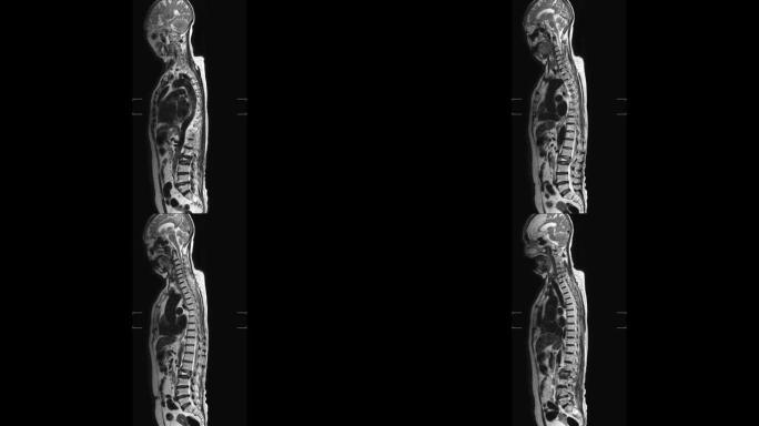腰椎的MRI研究揭示了L2椎体爆裂性骨折并严重椎体塌陷和腰椎病从L1-2到L5-S1椎间盘。医学概念
