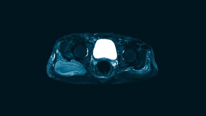 髋关节矢状面磁共振成像 (MRI)。在右臀大肌和臀中肌的肌内区域找到一个大型的混合异质液体集合。