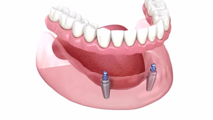 下颌骨可移动假体全部在2系统上由带有球附件的植入物支撑。医学上精确的牙科3D动画。