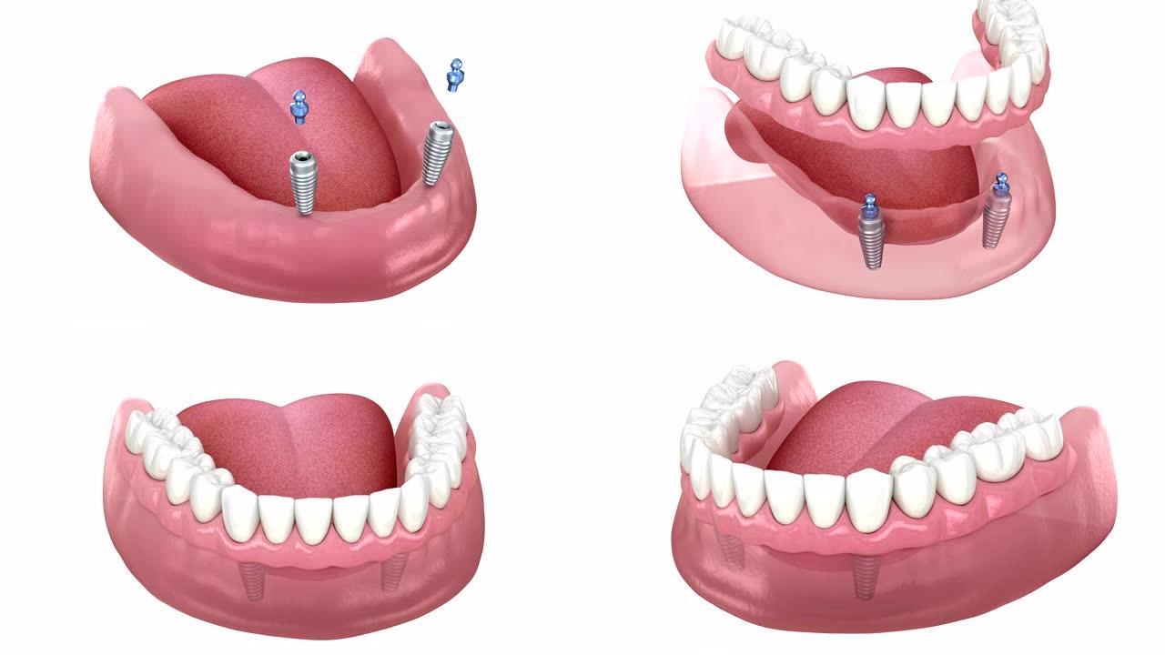 下颌骨可移动假体全部在2系统上由带有球附件的植入物支撑。医学上精确的牙科3D动画。